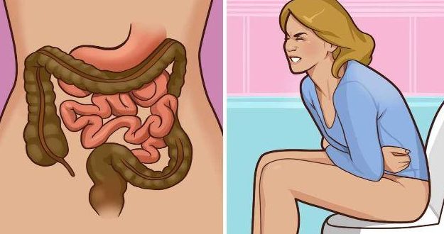 5 dấu hiệu cảnh báo ung thư đại trực tràng